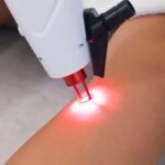 Vantagens do laser para varizes